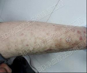 ��Ѫ�Ʒ����һָ�����