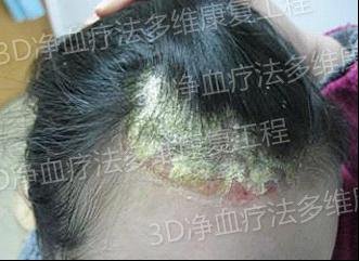 青春美丽从治愈银屑病开始