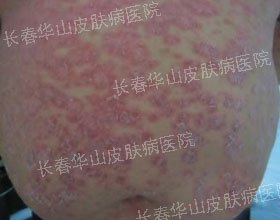 腹部银屑病治愈,还他朝气蓬勃