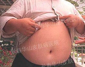 腹部银屑病治愈,还他朝气蓬勃