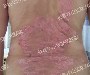 五年背部银屑病治疗