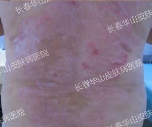 五年背部银屑病治疗