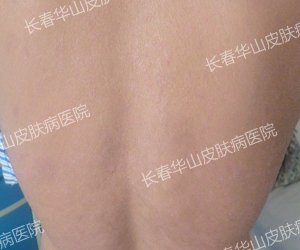 五年背部银屑病治疗
