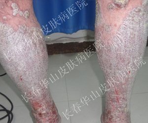 皮损消退,沐浴夏日阳光