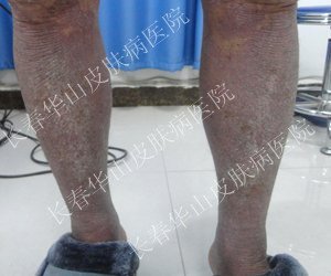 皮损消退,沐浴夏日阳光