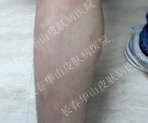 皮损消退,沐浴夏日阳光