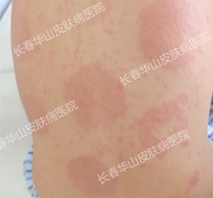 Ƥ����ʧ�������ɱ�