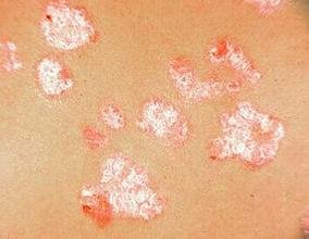 牛皮癣对患者的影响