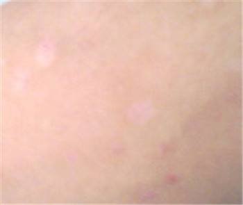 牛皮癣有哪些病症体现