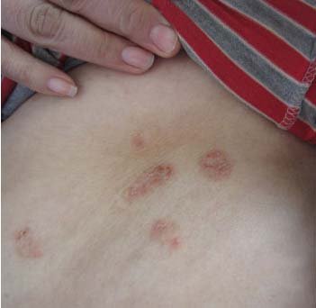 治疗牛皮癣注意的方面