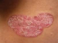 患上牛皮癣患者怎么办