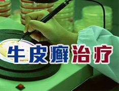 牛皮癣治疗有哪些误区