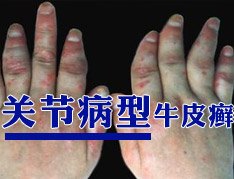 怎么治疗关节病型牛皮癣