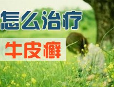 治疗牛皮癣有哪些方法
