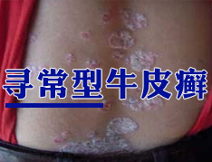 寻常型牛皮癣的症状有哪些